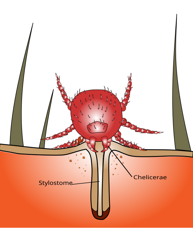 chigger bite