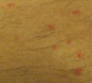 flea bites on human, flea bites on the lower leg of a human subject.