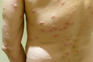 bed bug bites